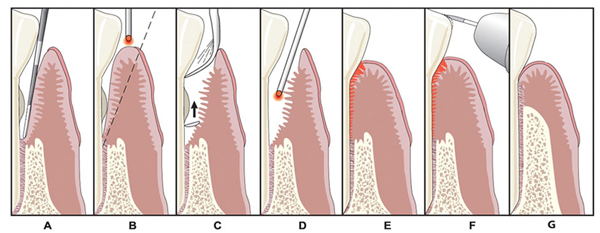laser gum surgery in Nashville, TN