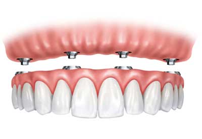Implant Supported Dentures in Nashville, TN