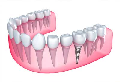 Single Missing Tooth in Nashville, TN