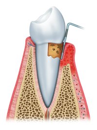 Periodontitis in Nashville, TN