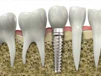Dental Implants in Nashville, TN