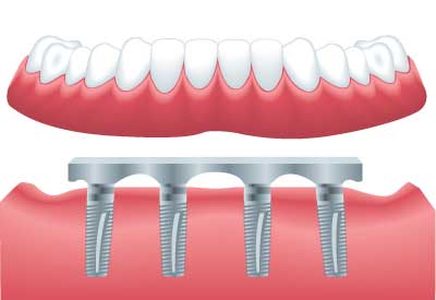 Implant Supported Dentures in Louisville, KY