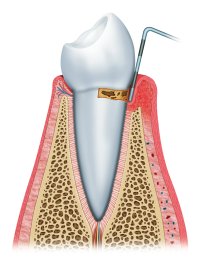 Gum Disease in Nashville, TN