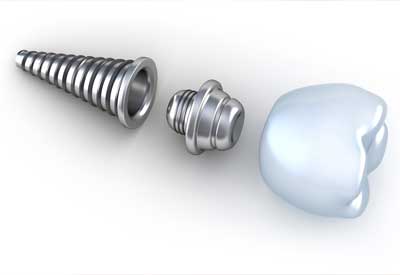 dental implants in Nashville, TN