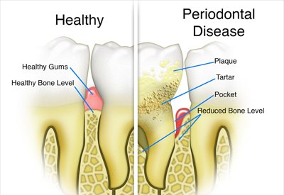 Gum Disease and Tooth and Bone Loss Louisville, KY